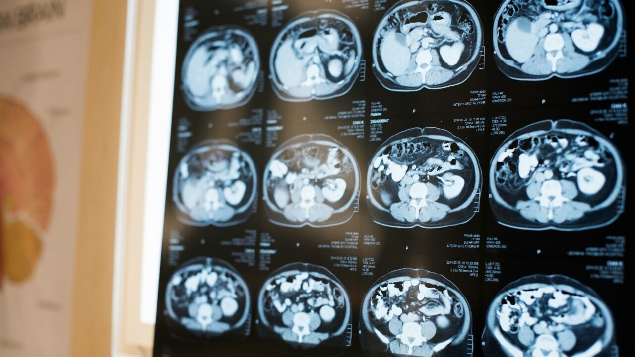 Datos LIACDD sobre VIF y demencia en adultos mayores